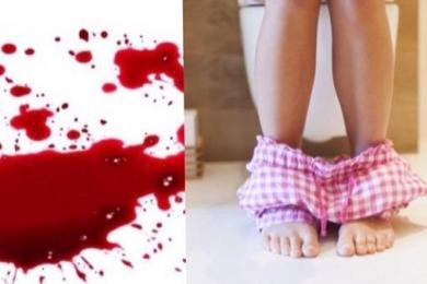 Anal fissür (Makat çatlağı, yırtığı)