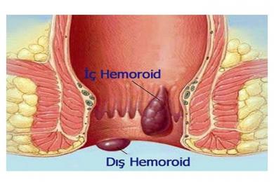 HEMOROİD NEDİR?