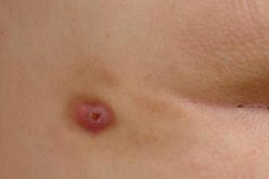 KIL DÖNMESİNİN (PYLONİDAL SİNÜS) BELİRTİLERİ