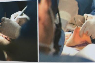 MEME REKONSRÜKSİYONU