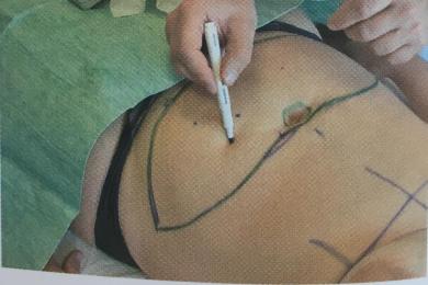 MEME KANSERİNDE YENİDEN ONARIMIN AMACI 